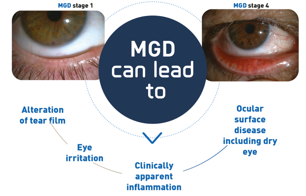 Symptoms of MGD